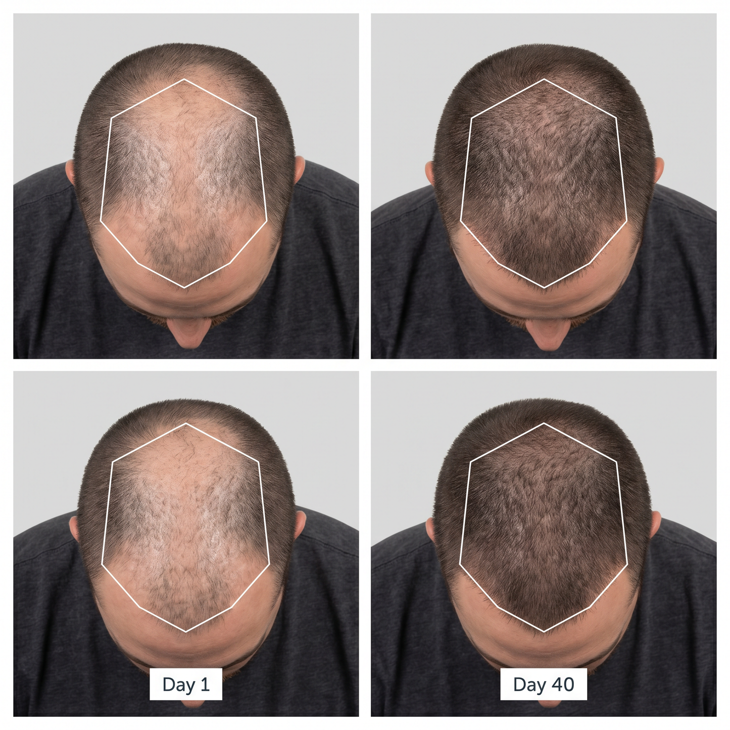 RegrowLab™ Red Light Hat