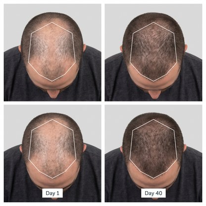 RegrowLab™ Red Light Hat